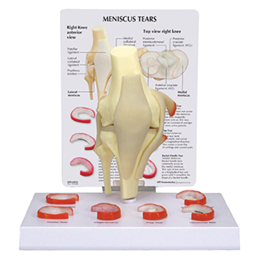 Meniscus Tear Knee Model – Full-size Right Knee