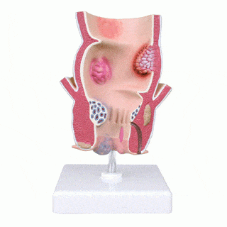 Anatomical Model Pathologic model of the Anal Canal