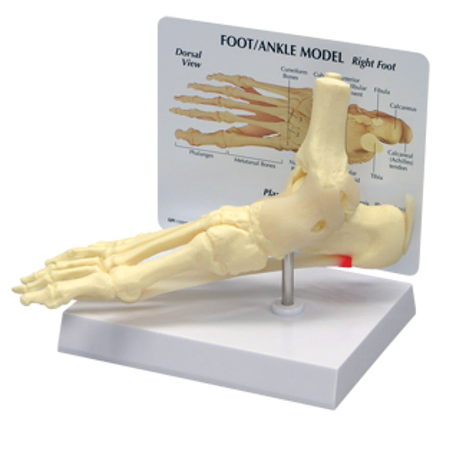 Full‑Size Solid Cast Foot & Ankle Model — Plantar Fasciitis (Spring Ligaments)