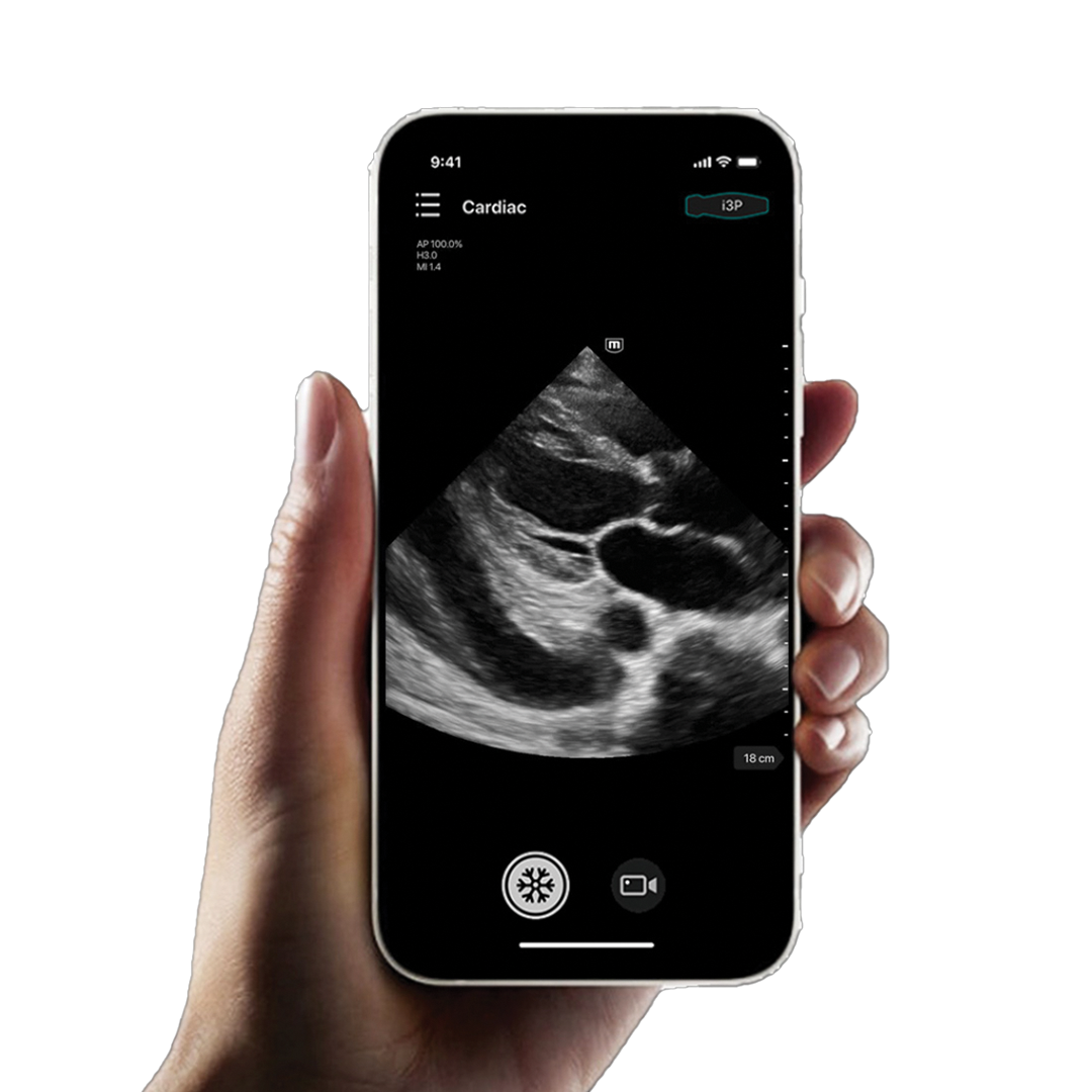 Wireless handheld ultrasound for point-of-care imaging