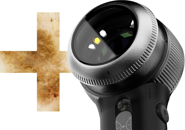 DermLite DL5 Plus Dermatoscope