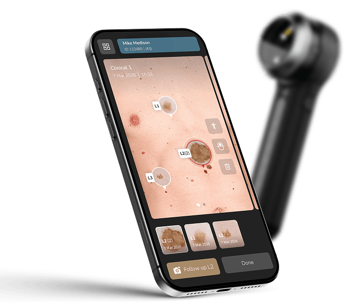 DermLite DL5 Plus Dermatoscope
