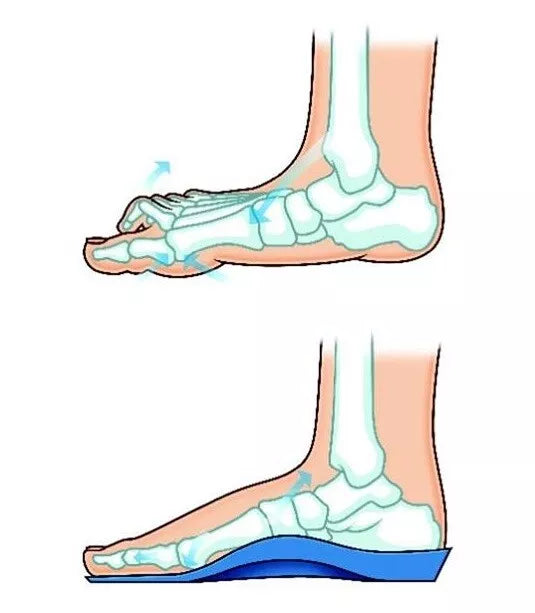 Talarmade Elevate - Medium Density, Heat Mouldable Modular Orthotic Kit for Customised Patient Fit