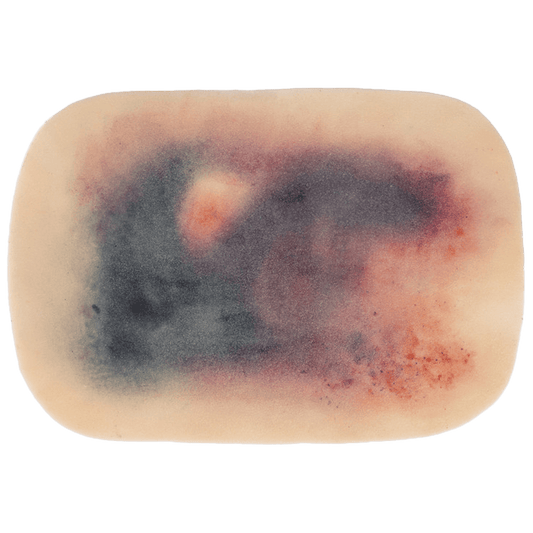 TraumaSim Self-Adhesive Large Haematoma