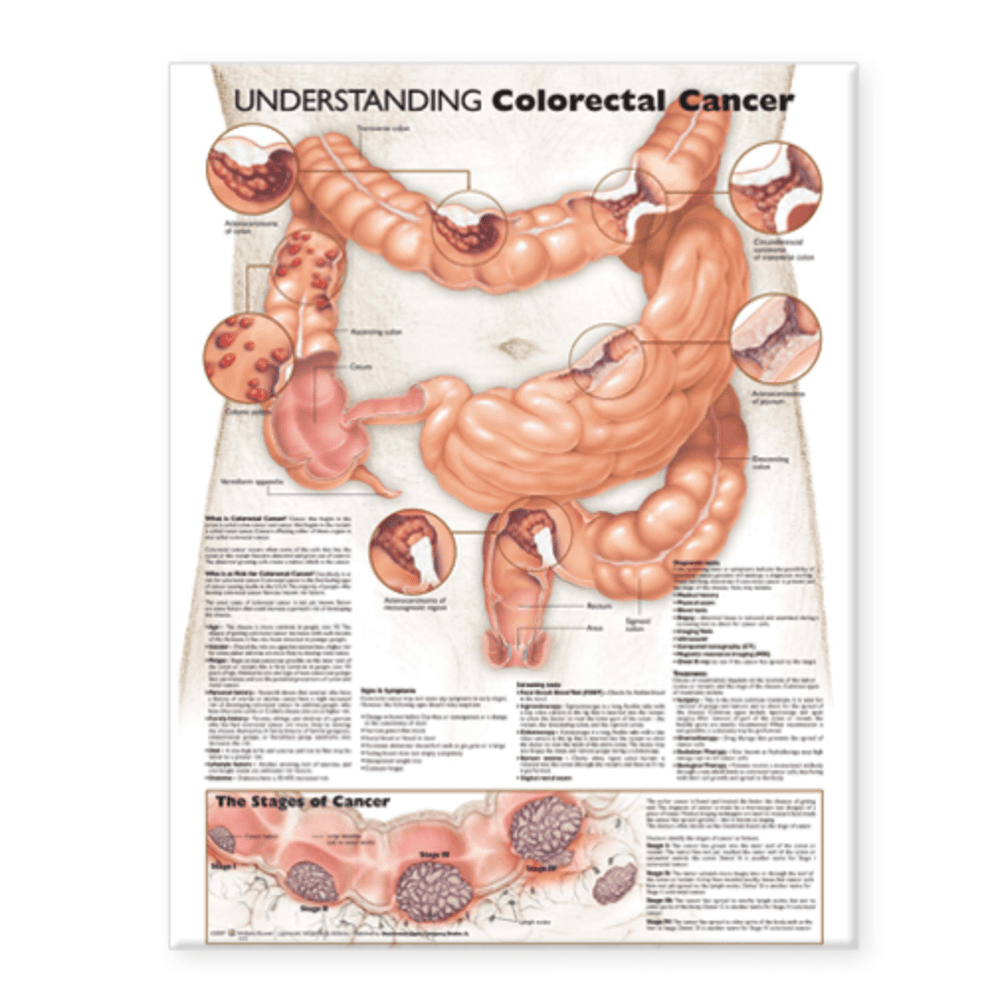 Understanding Colorectal Cancer Anatomical Chart – Medshop Australia