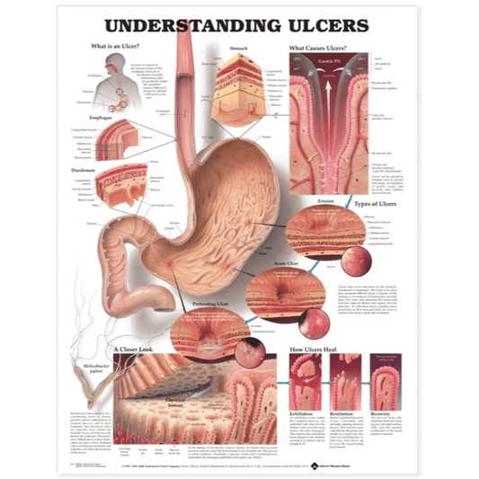 Anatomical Chart Company Anatomical Charts Understanding Ulcers Anatomical Chart